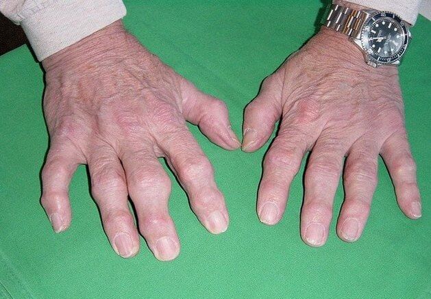 Osteoartrita degetelor
