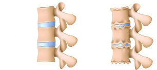 Mecanismul dezvoltării osteochondrozei