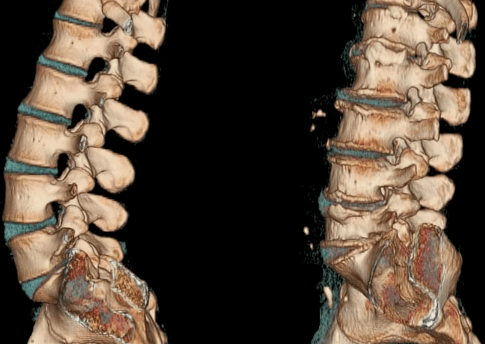 osteochondroză