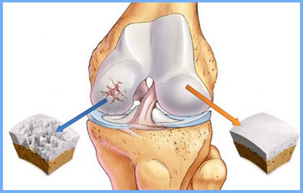 Articulația normală a genunchiului și afectată de artroză