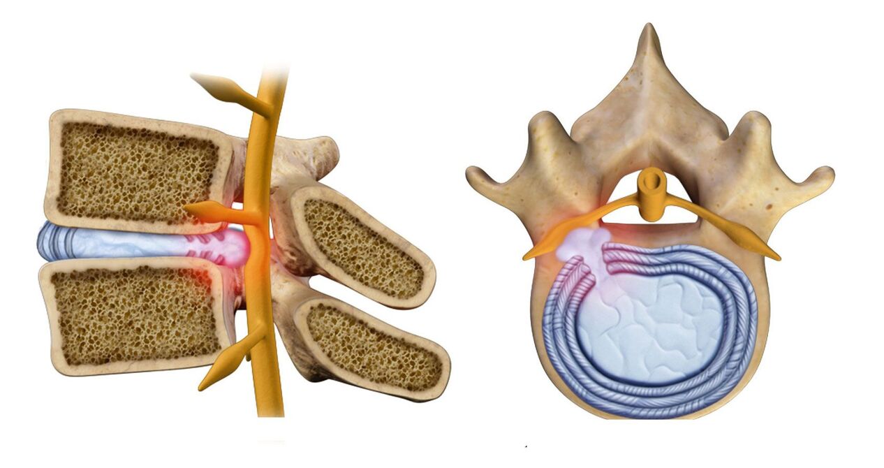 hernia spinală în osteocondroza toracică