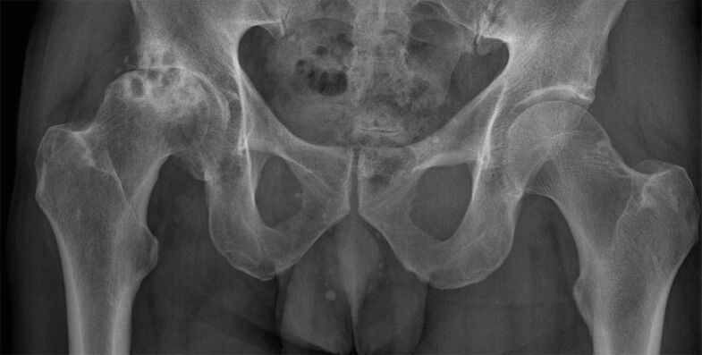 Artroza deformantă a articulației șoldului la radiografie