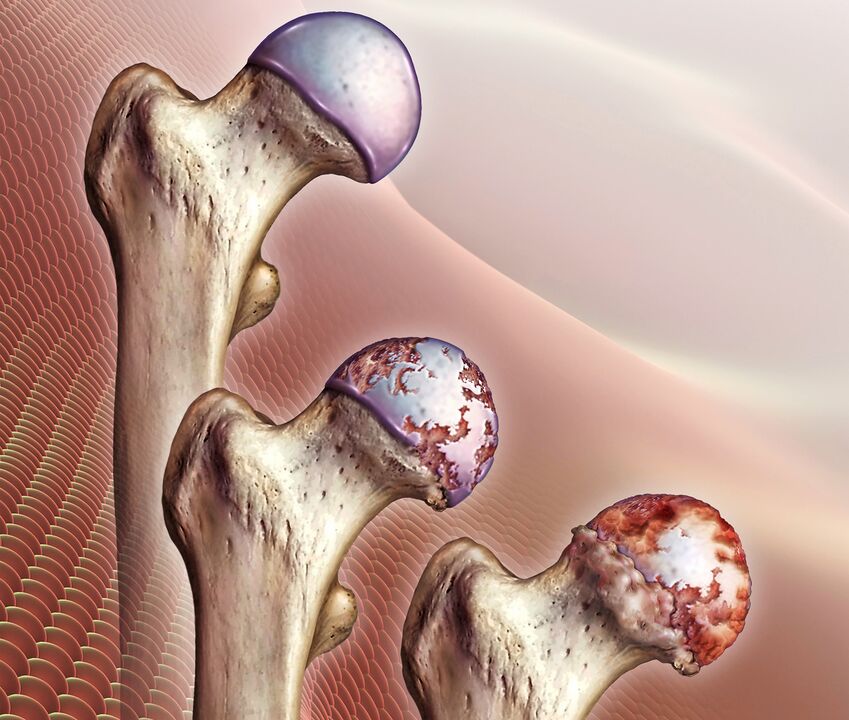 Dezvoltarea artrozei articulației șoldului
