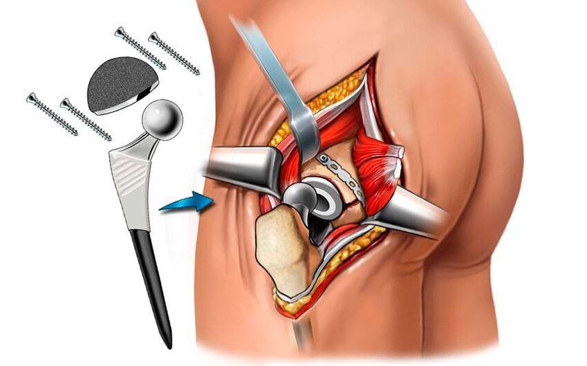 Instalarea unei endoproteze - o soluție chirurgicală la problema coxartrozei