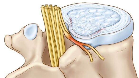 Osteocondroza lombară poate duce la complicații sub formă de hernie intervertebrală