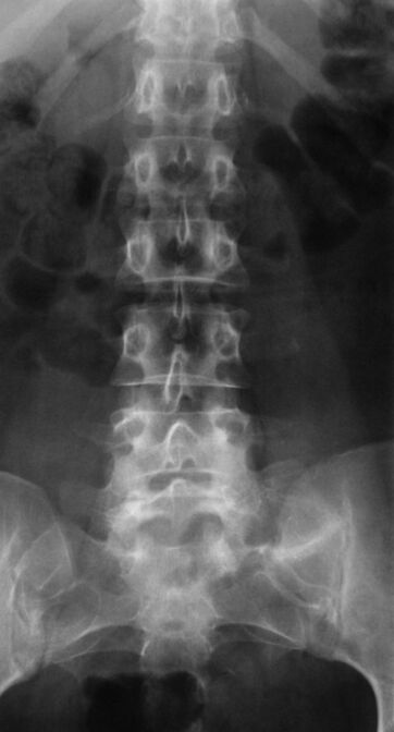 Pentru a diagnostica osteocondroza lombară, se efectuează radiografie