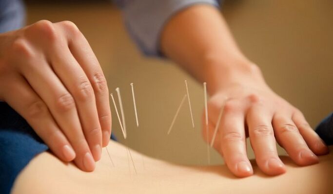 acupunctura pentru tratarea durerilor de spate