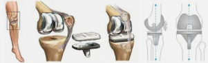 Artroplastia de exemplu genunchi